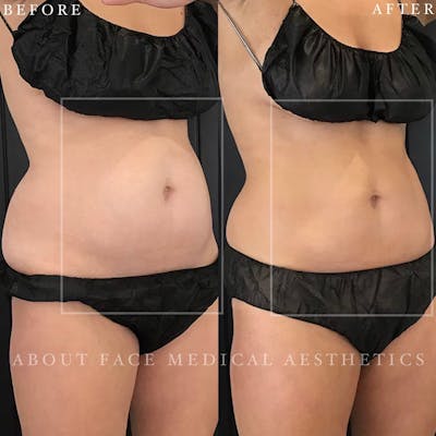 CoolSculpting Before & After Gallery - Patient 152123999 - Image 1