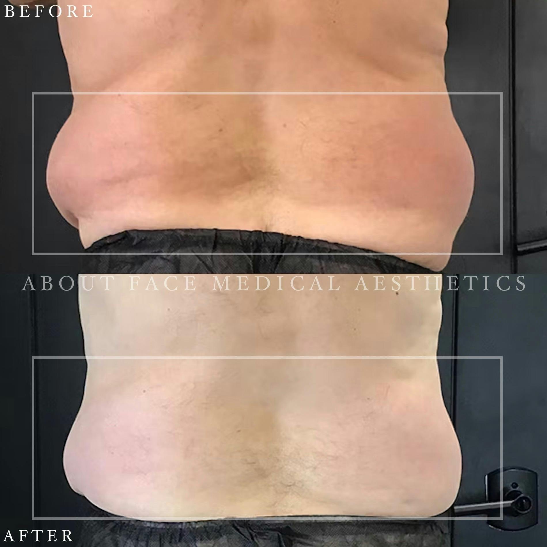 CoolSculpting Before & After Gallery - Patient 152124208 - Image 1