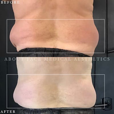 CoolSculpting Before & After Gallery - Patient 152124208 - Image 1