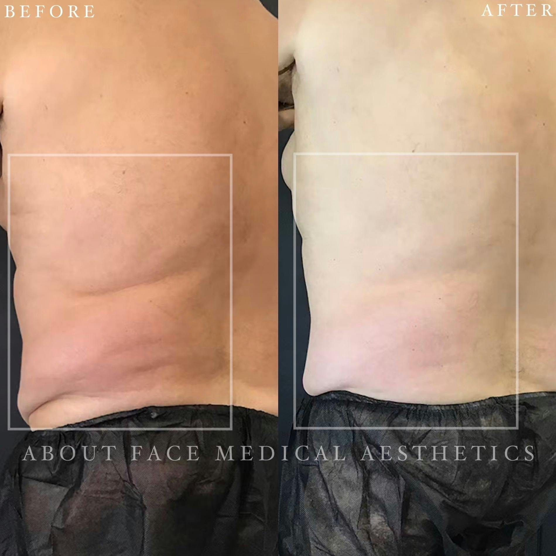 CoolSculpting Before & After Gallery - Patient 152124209 - Image 1