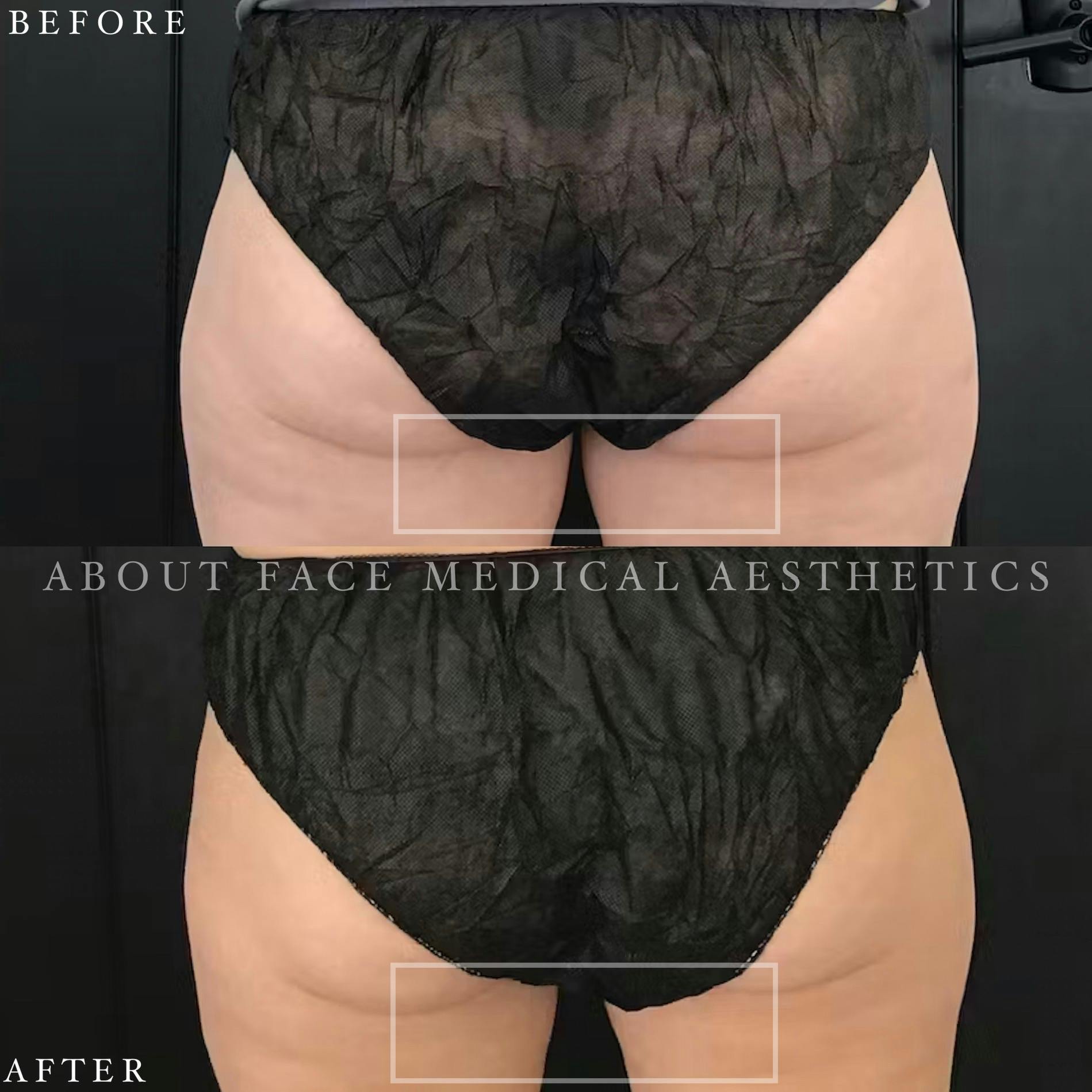 CoolSculpting Before & After Gallery - Patient 152124210 - Image 1