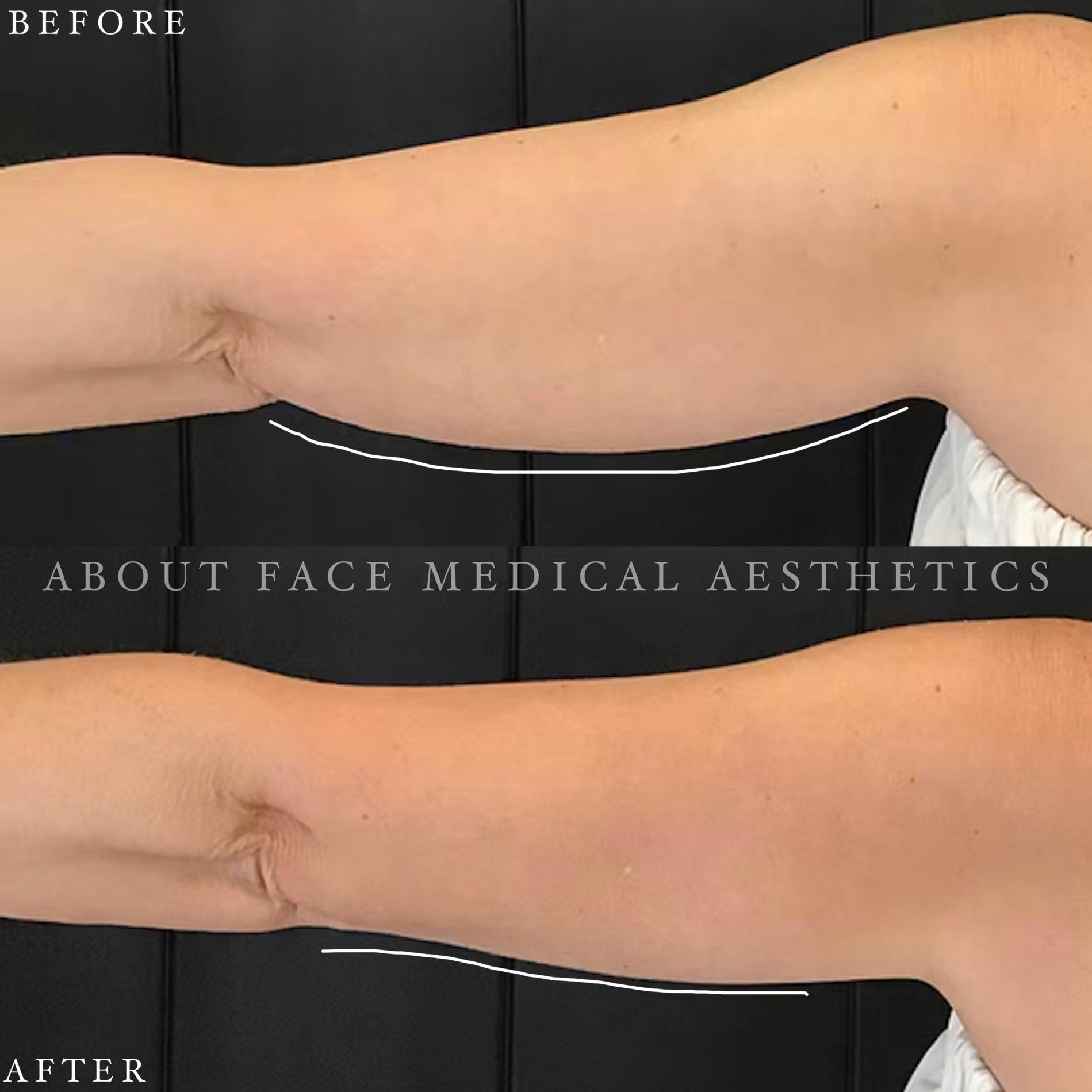 CoolSculpting Before & After Gallery - Patient 152124211 - Image 1