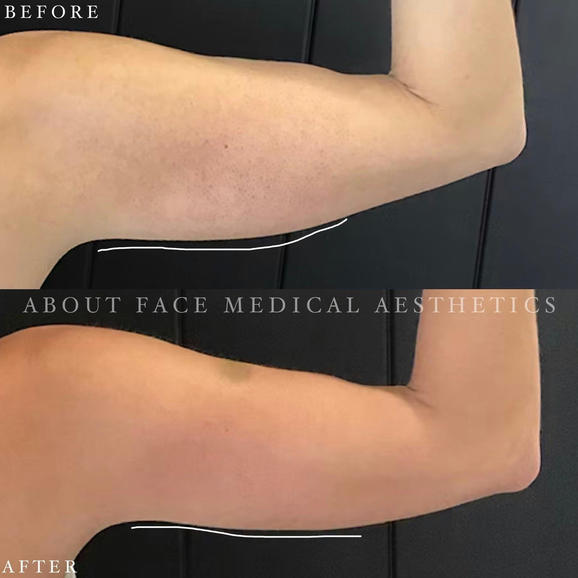 CoolSculpting Before & After Gallery - Patient 152124212 - Image 1
