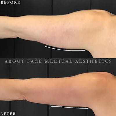 CoolSculpting Before & After Gallery - Patient 152124213 - Image 1
