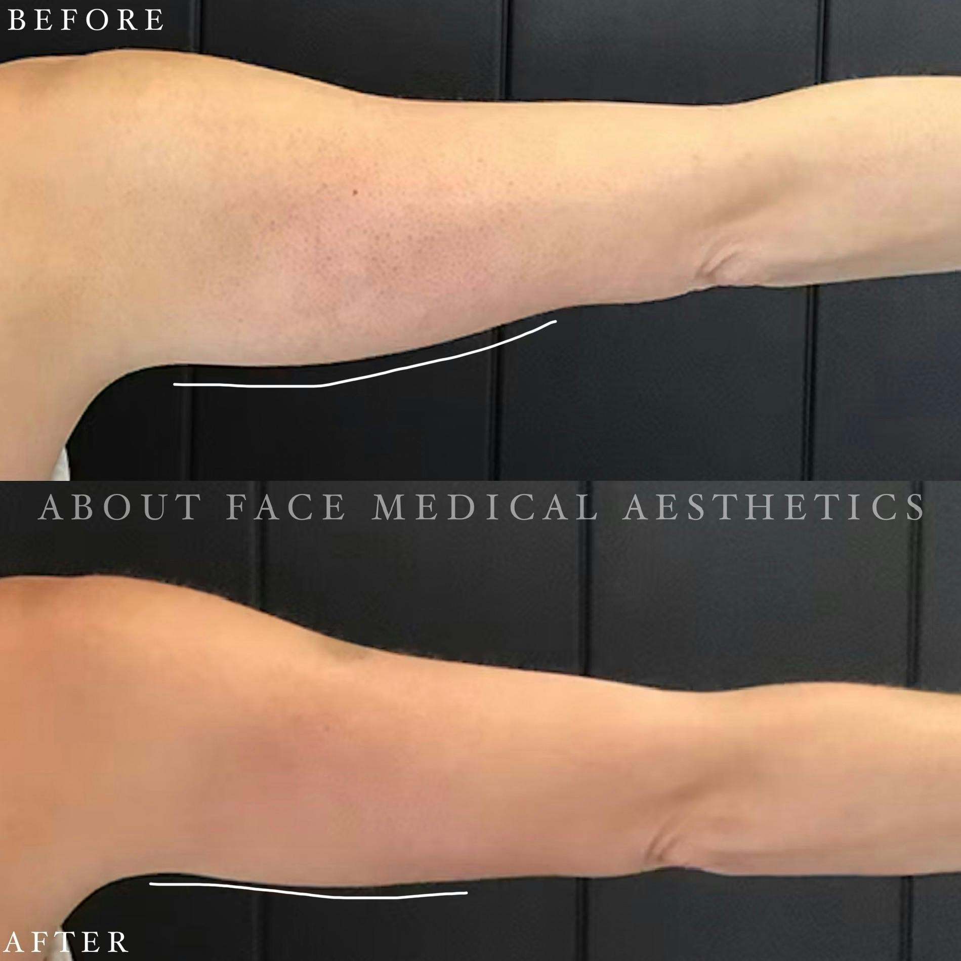 CoolSculpting Before & After Gallery - Patient 152124214 - Image 1
