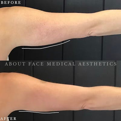 CoolSculpting Before & After Gallery - Patient 152124214 - Image 1