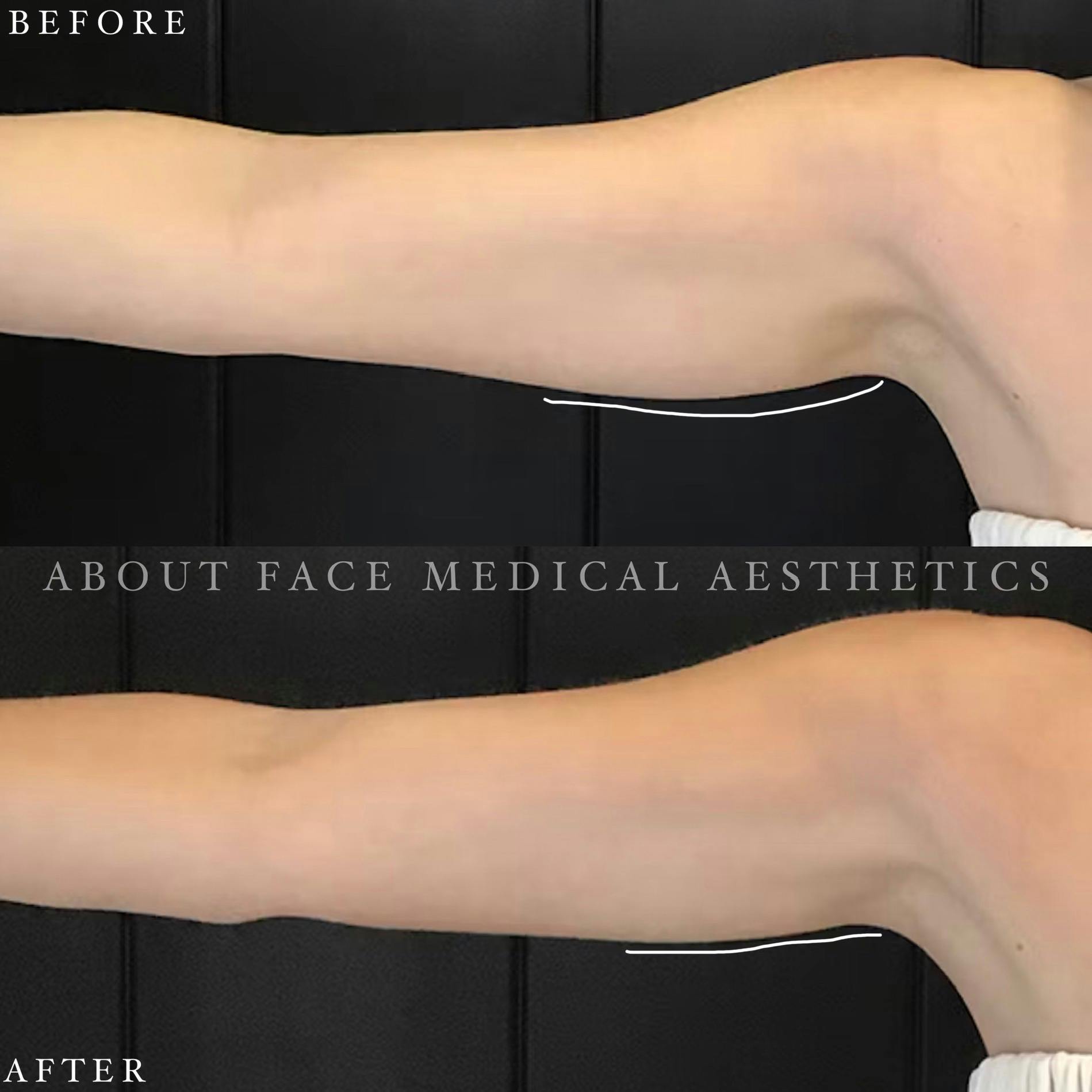 CoolSculpting Before & After Gallery - Patient 152124215 - Image 1