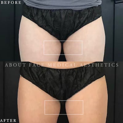 CoolSculpting Before & After Gallery - Patient 152124216 - Image 1