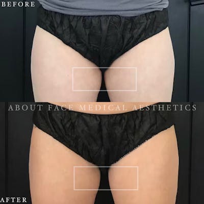 CoolSculpting Before & After Gallery - Patient 152124216 - Image 1