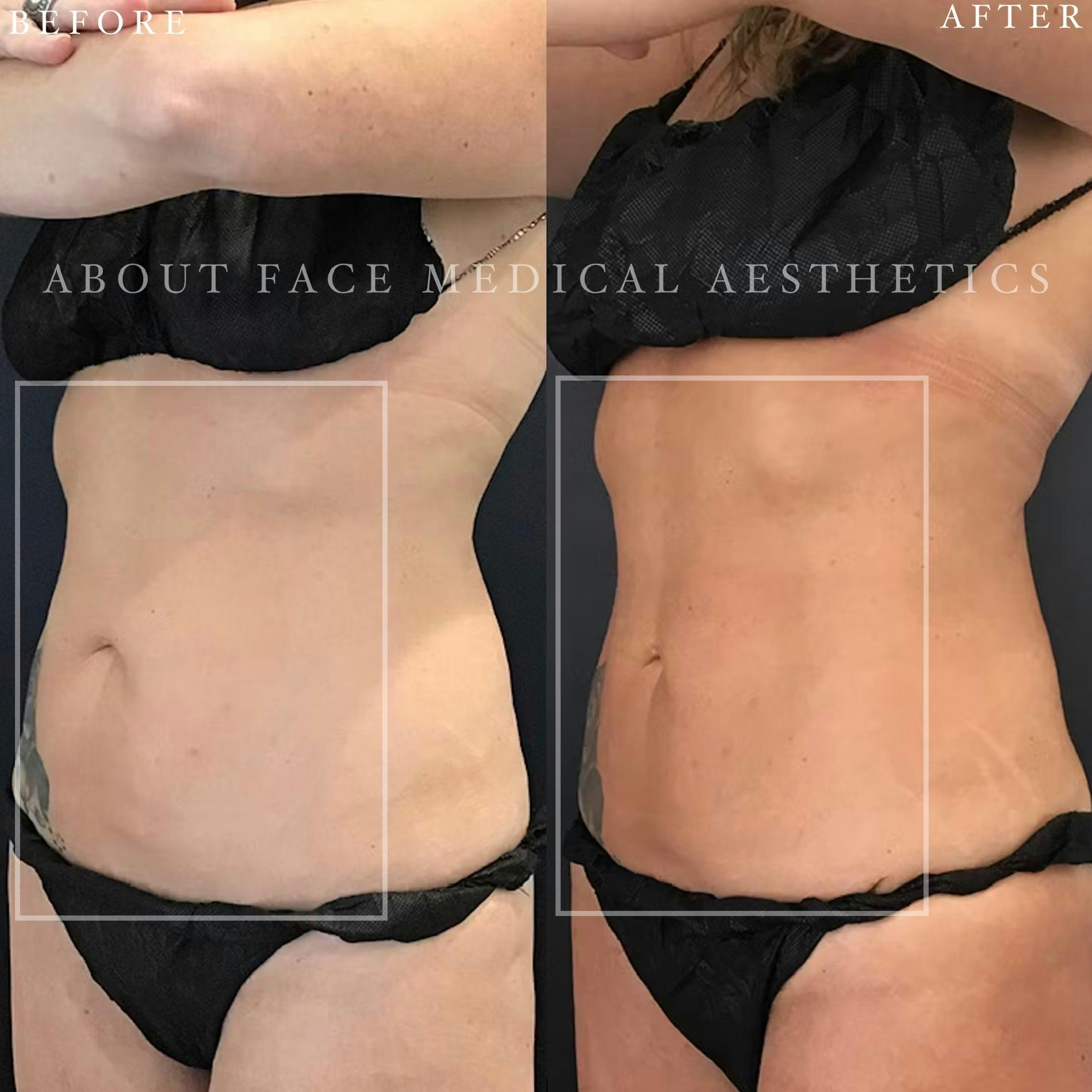 CoolSculpting Before & After Gallery - Patient 152124217 - Image 1