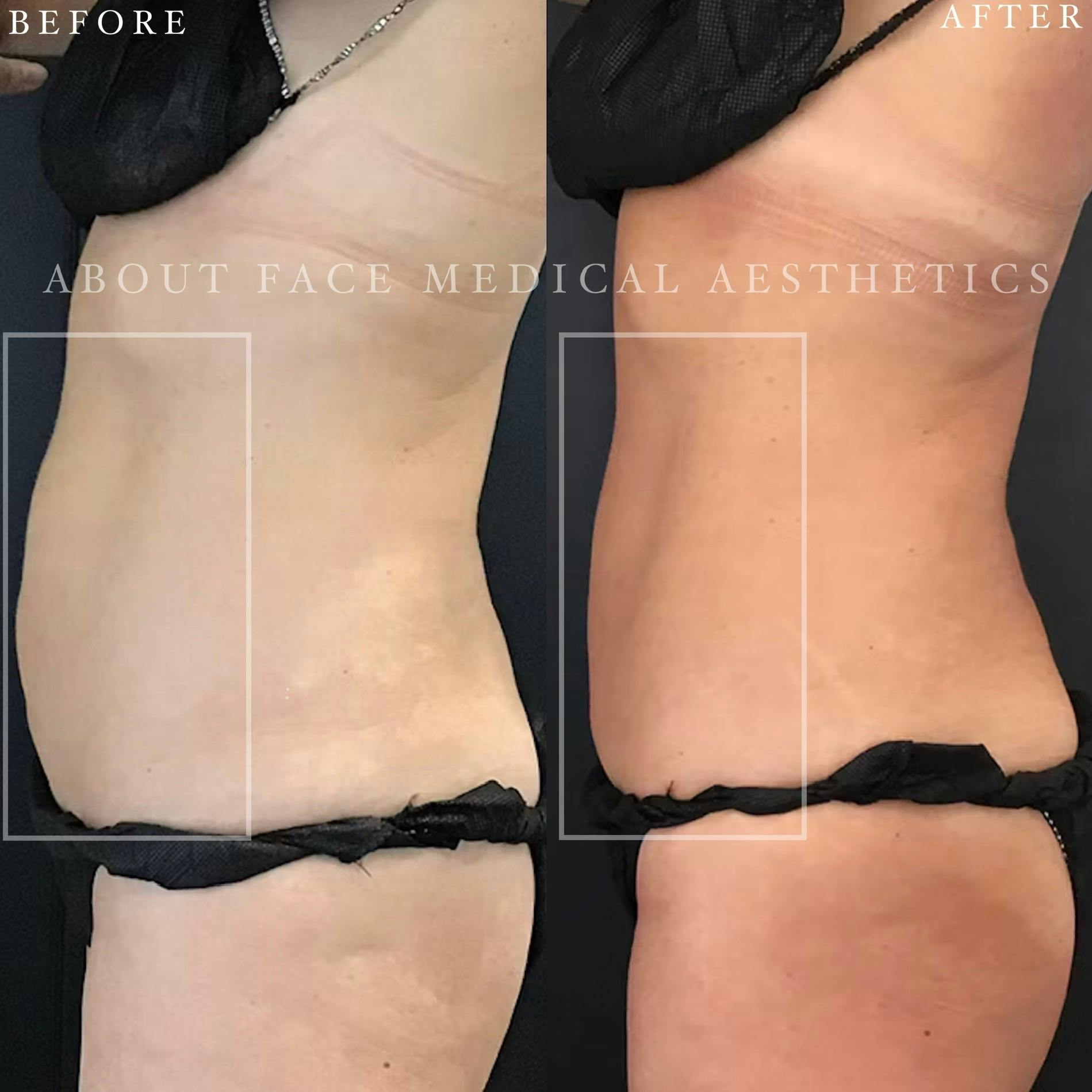 CoolSculpting Before & After Gallery - Patient 152124217 - Image 2