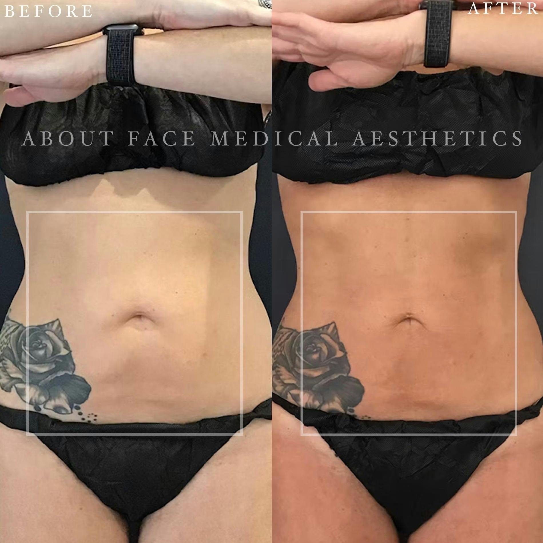 CoolSculpting Before & After Gallery - Patient 152124217 - Image 3