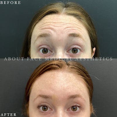 Botox Before & After Gallery - Patient 152124249 - Image 1