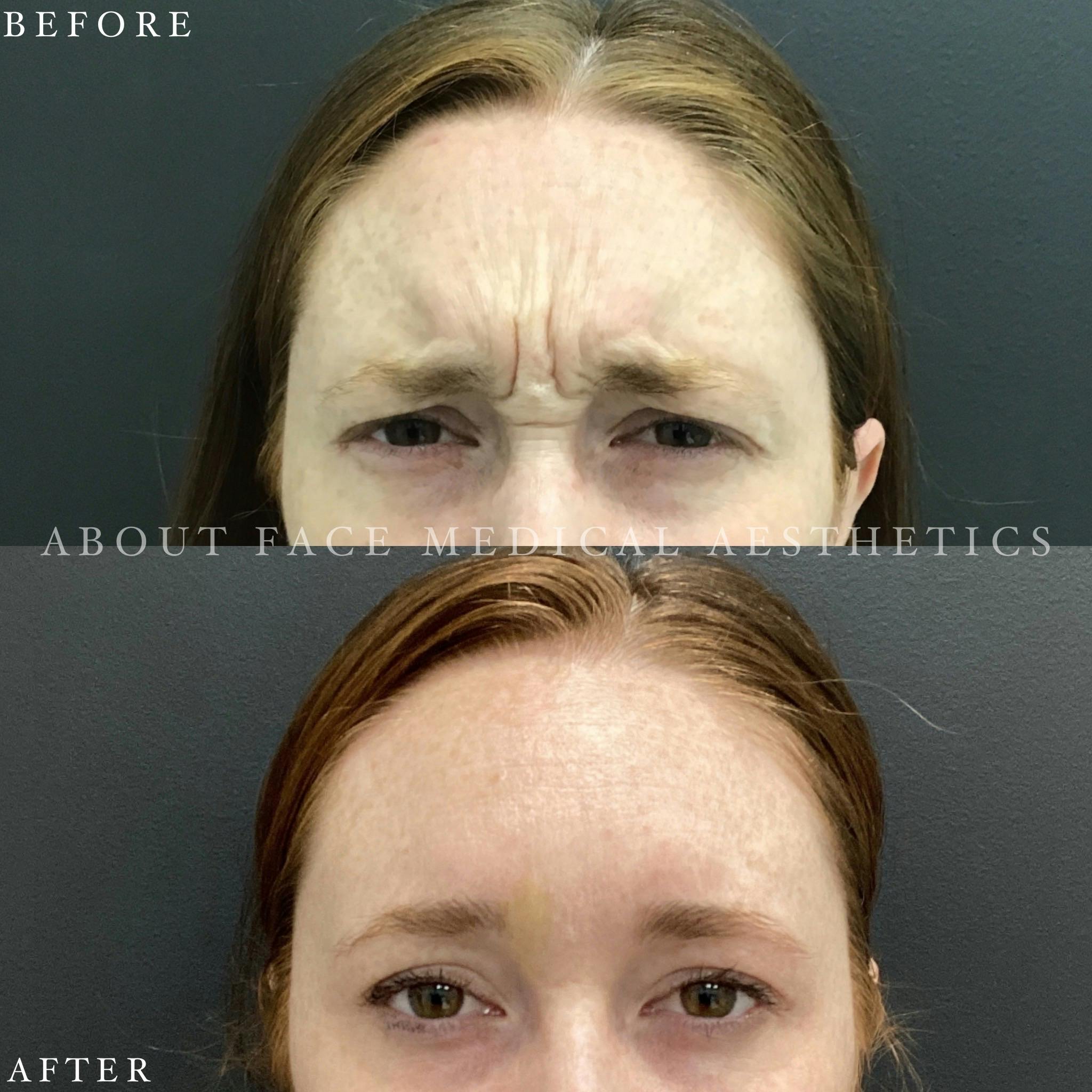 Botox Before & After Gallery - Patient 152124249 - Image 2