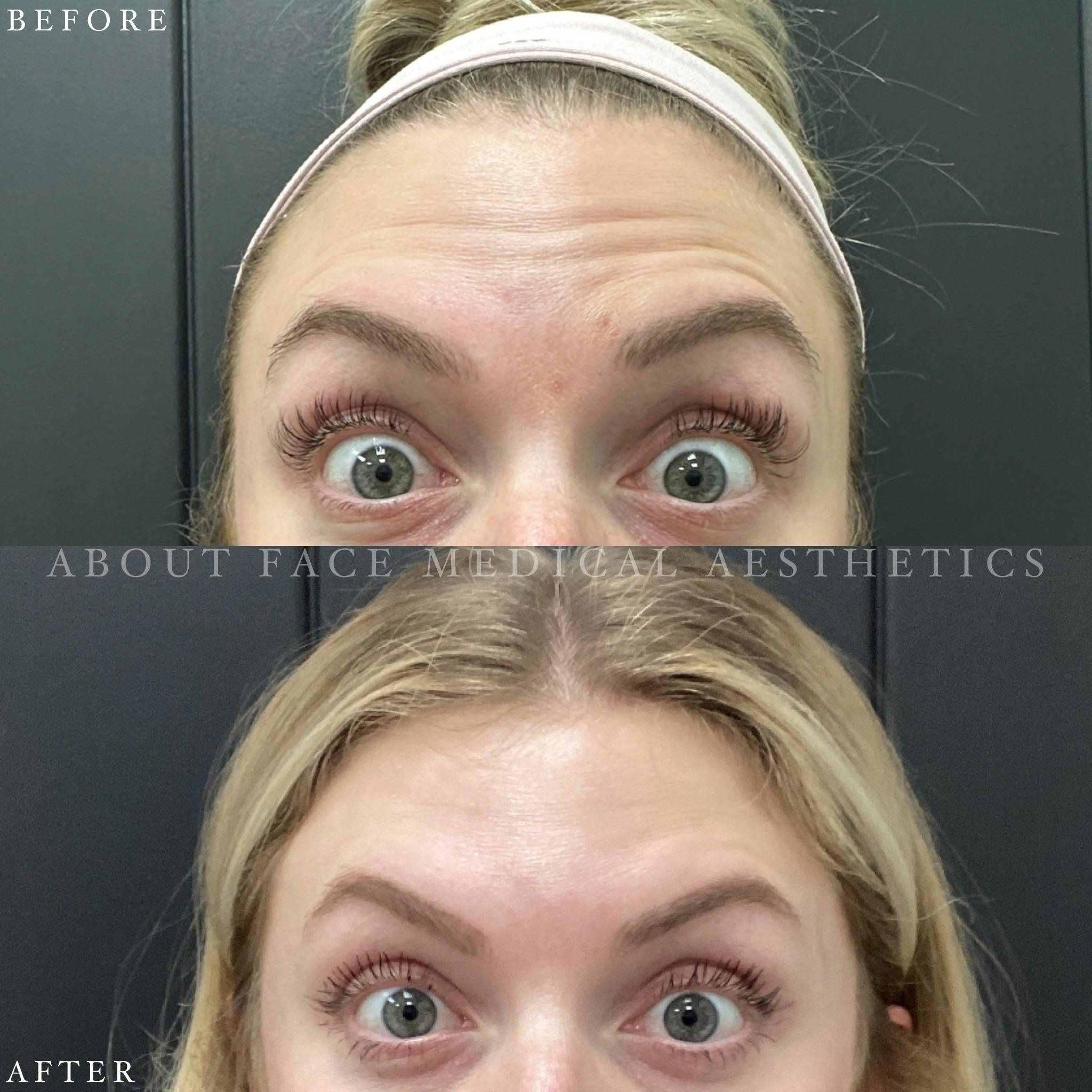 Botox Before & After Gallery - Patient 152124294 - Image 1