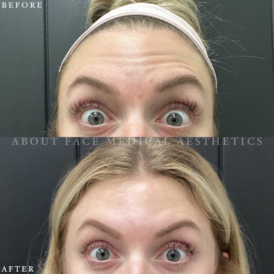 Botox Before & After Gallery - Patient 152124294 - Image 1