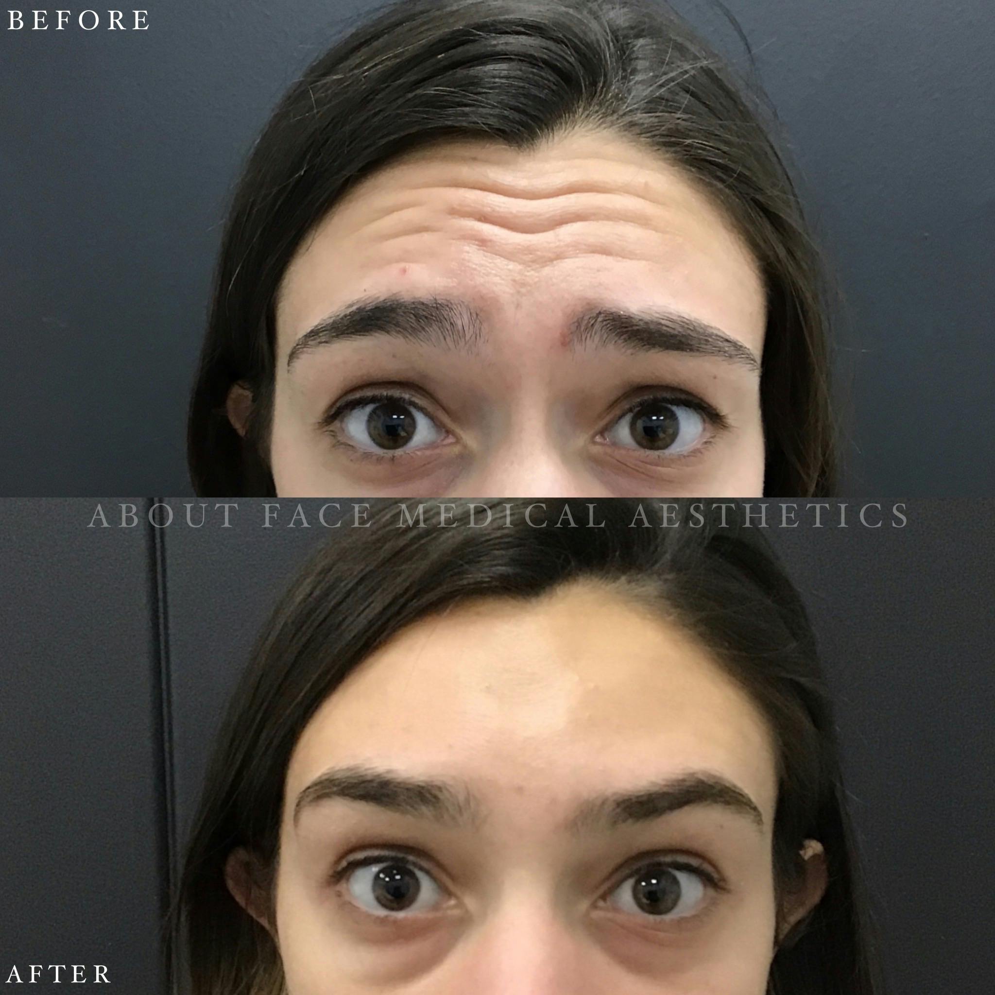 Botox Before & After Gallery - Patient 152124295 - Image 1