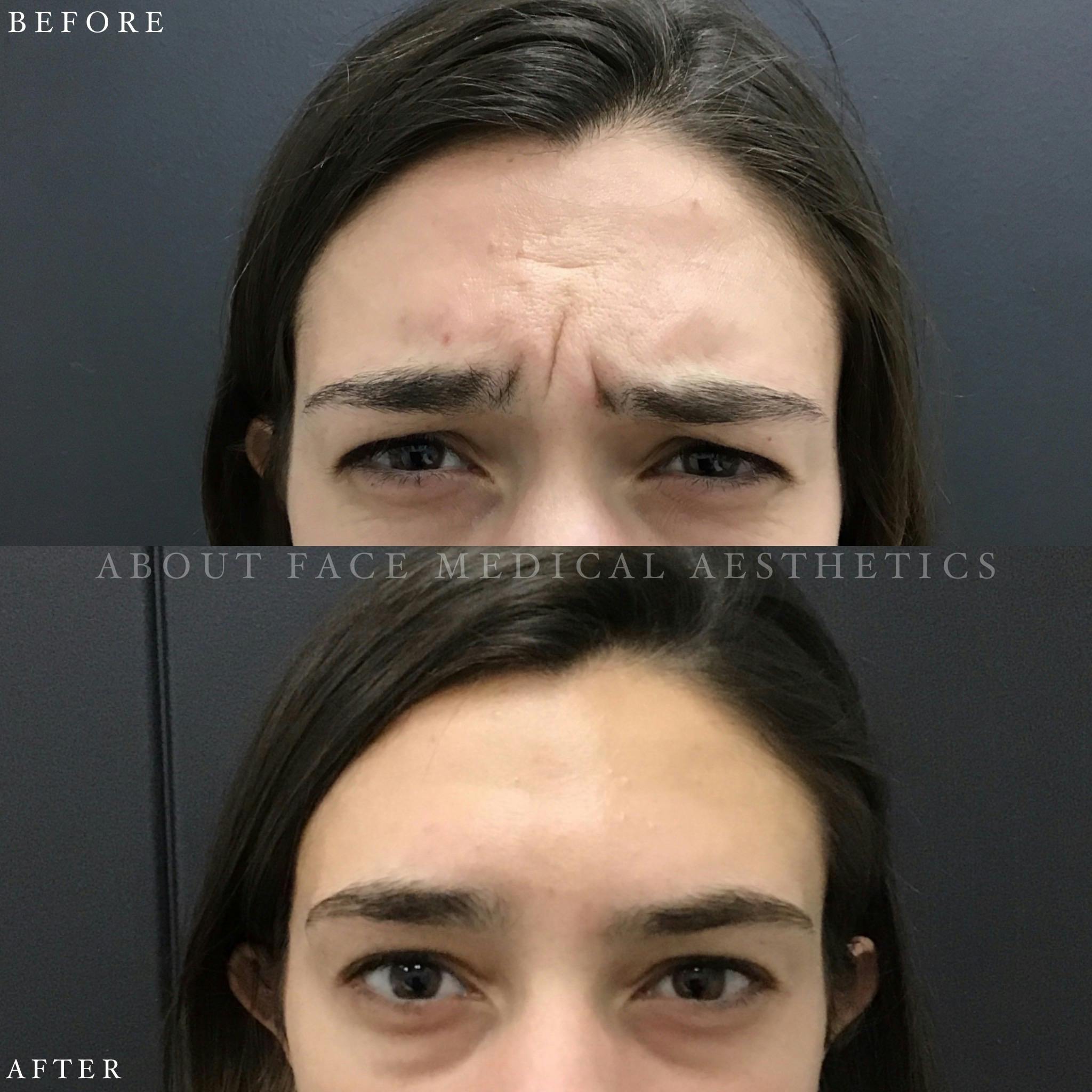 Botox Before & After Gallery - Patient 152124295 - Image 2
