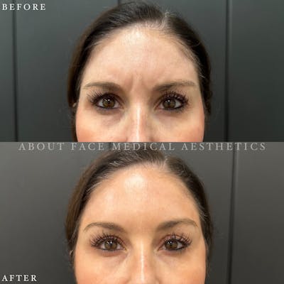 Botox Before & After Gallery - Patient 152124296 - Image 1