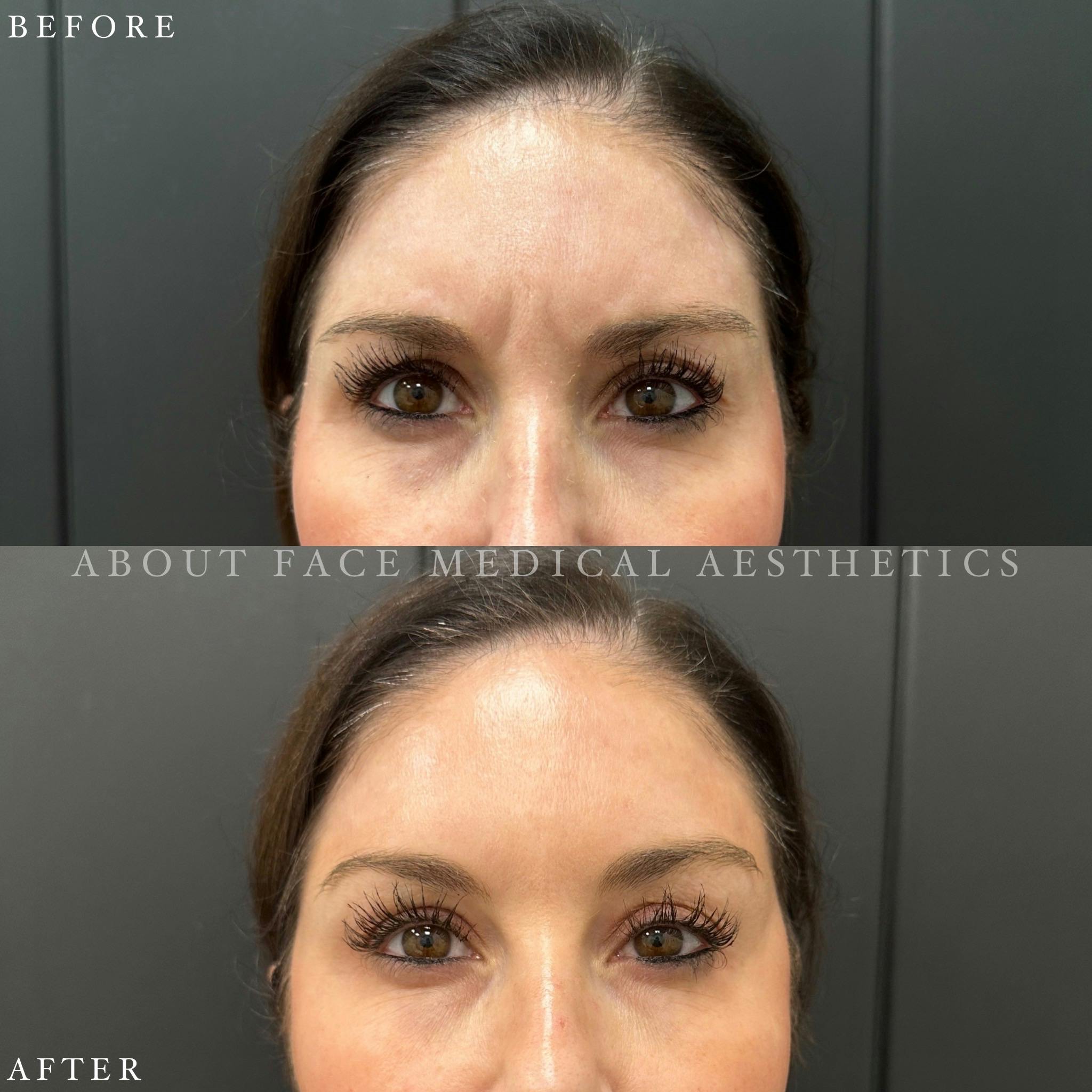 Botox Before & After Gallery - Patient 152124296 - Image 1