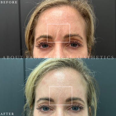 Botox Before & After Gallery - Patient 152124297 - Image 1