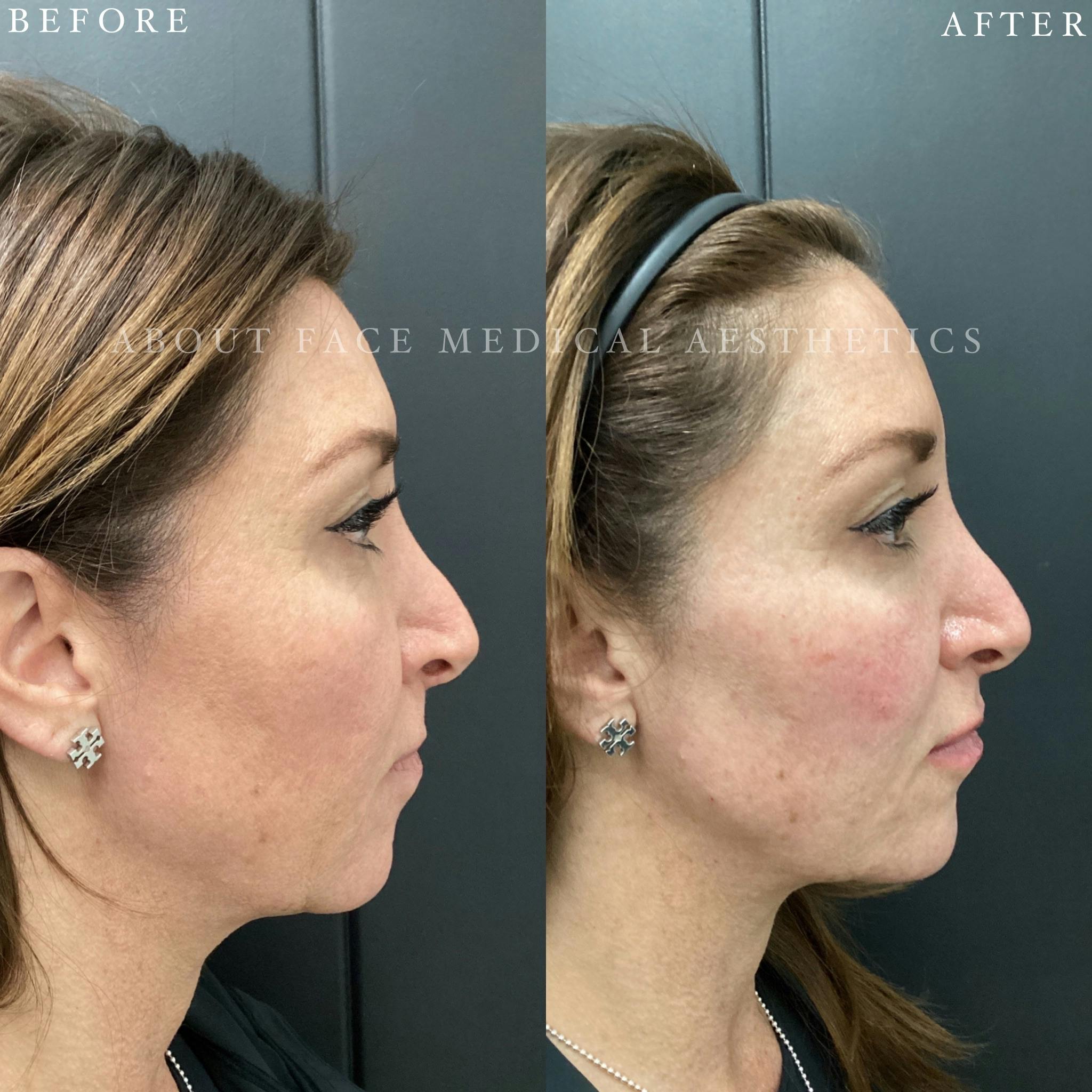 Dermal Filler Before & After Gallery - Patient 152124334 - Image 1