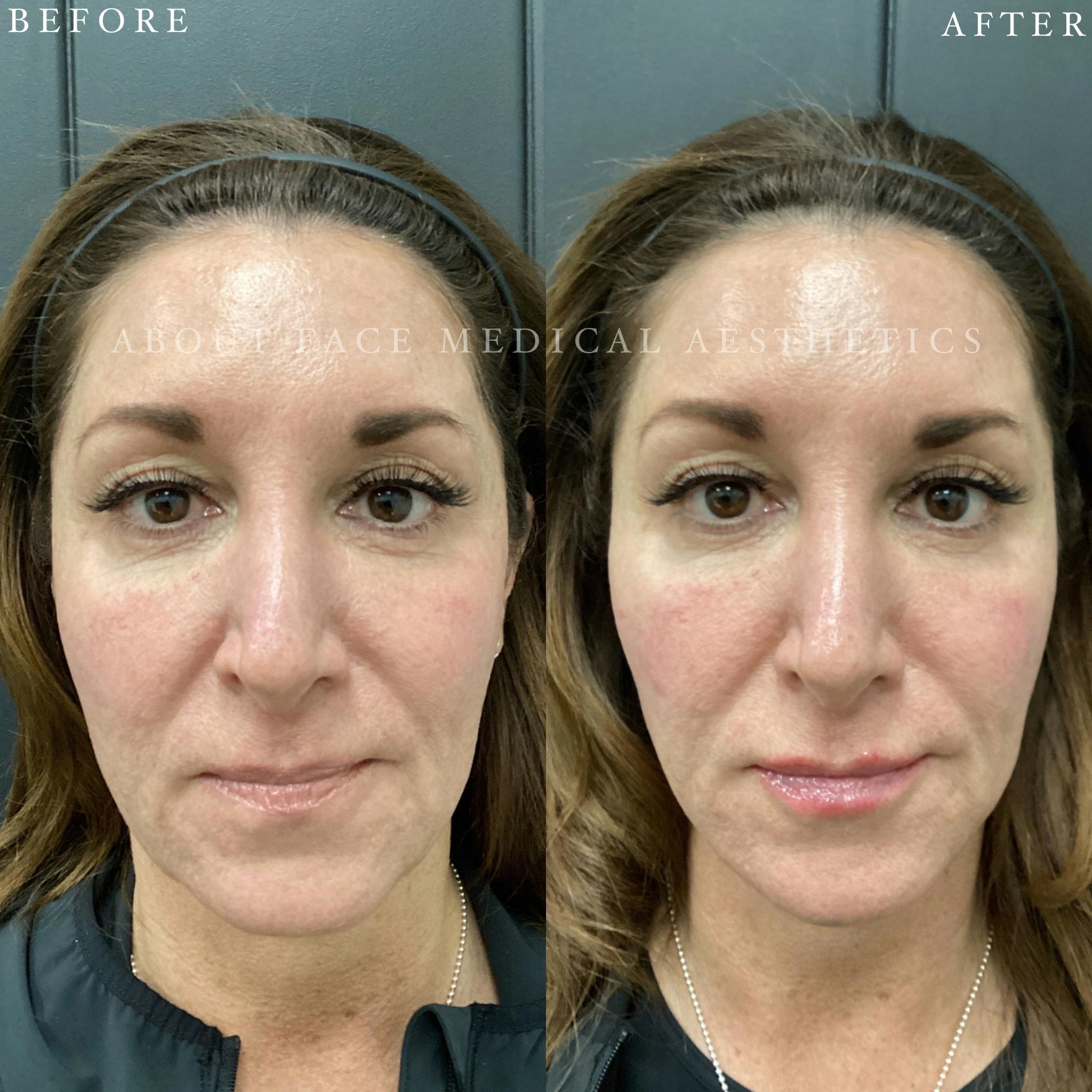 Dermal Filler Before & After Gallery - Patient 152124334 - Image 2