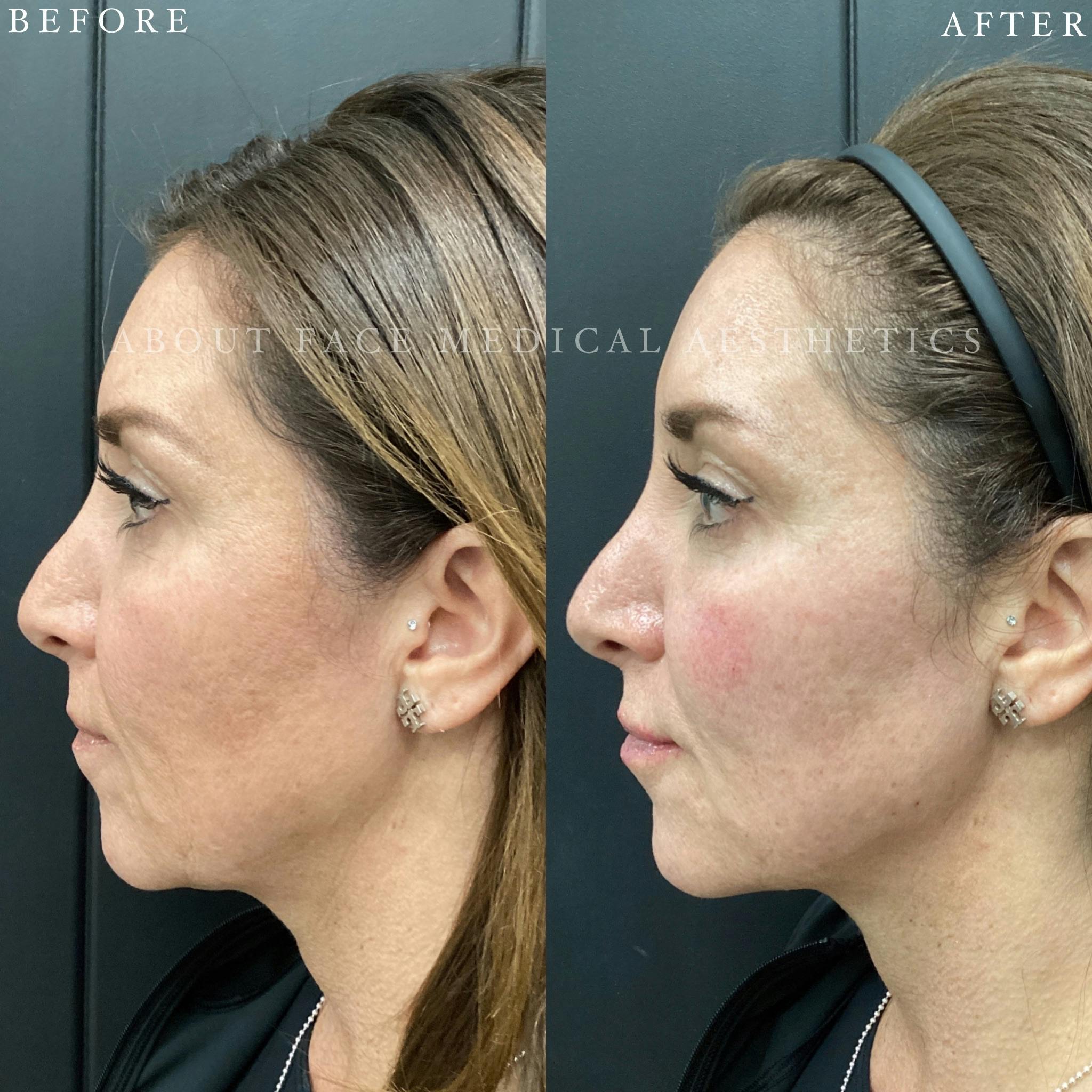 Dermal Filler Before & After Gallery - Patient 152124334 - Image 3