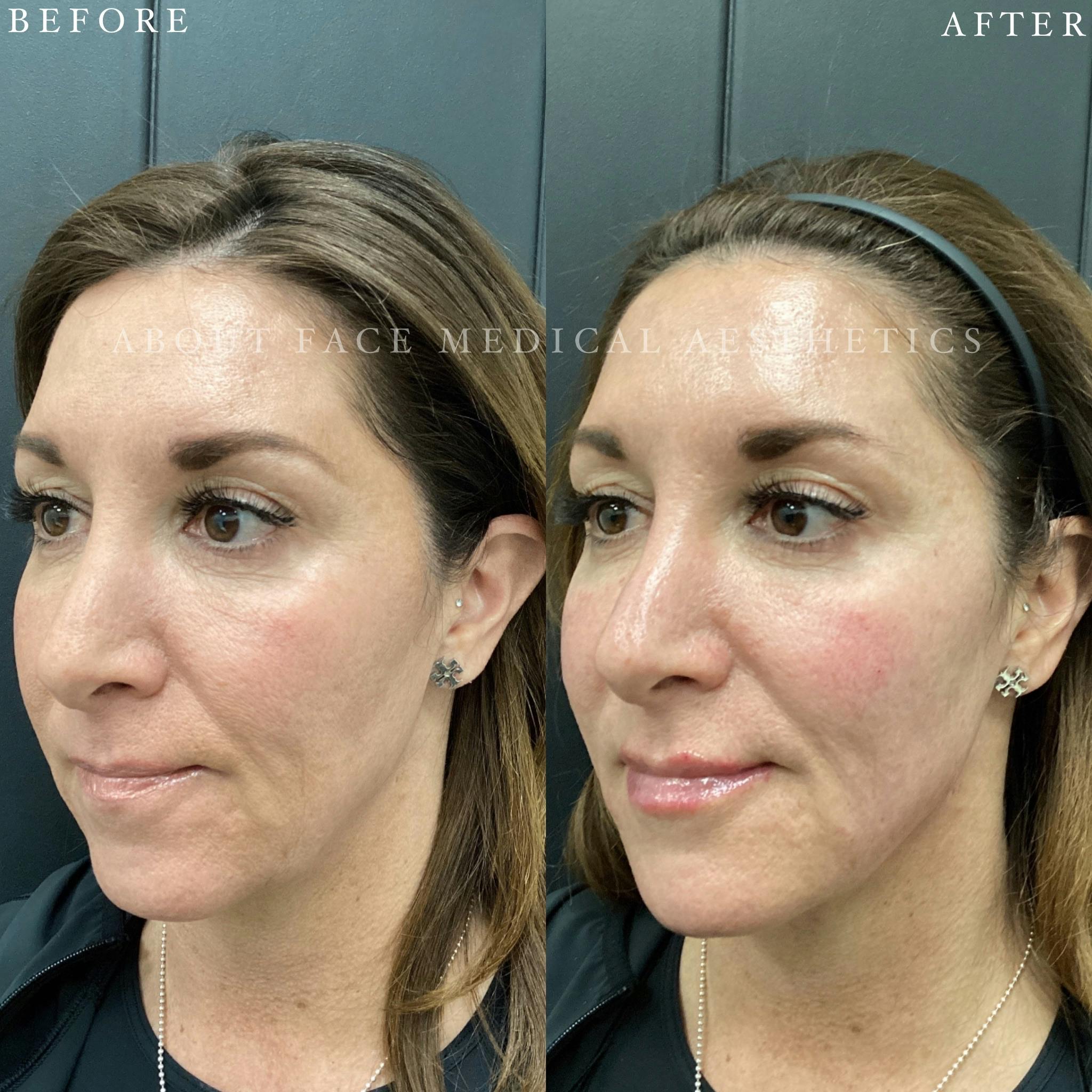 Dermal Filler Before & After Gallery - Patient 152124334 - Image 4