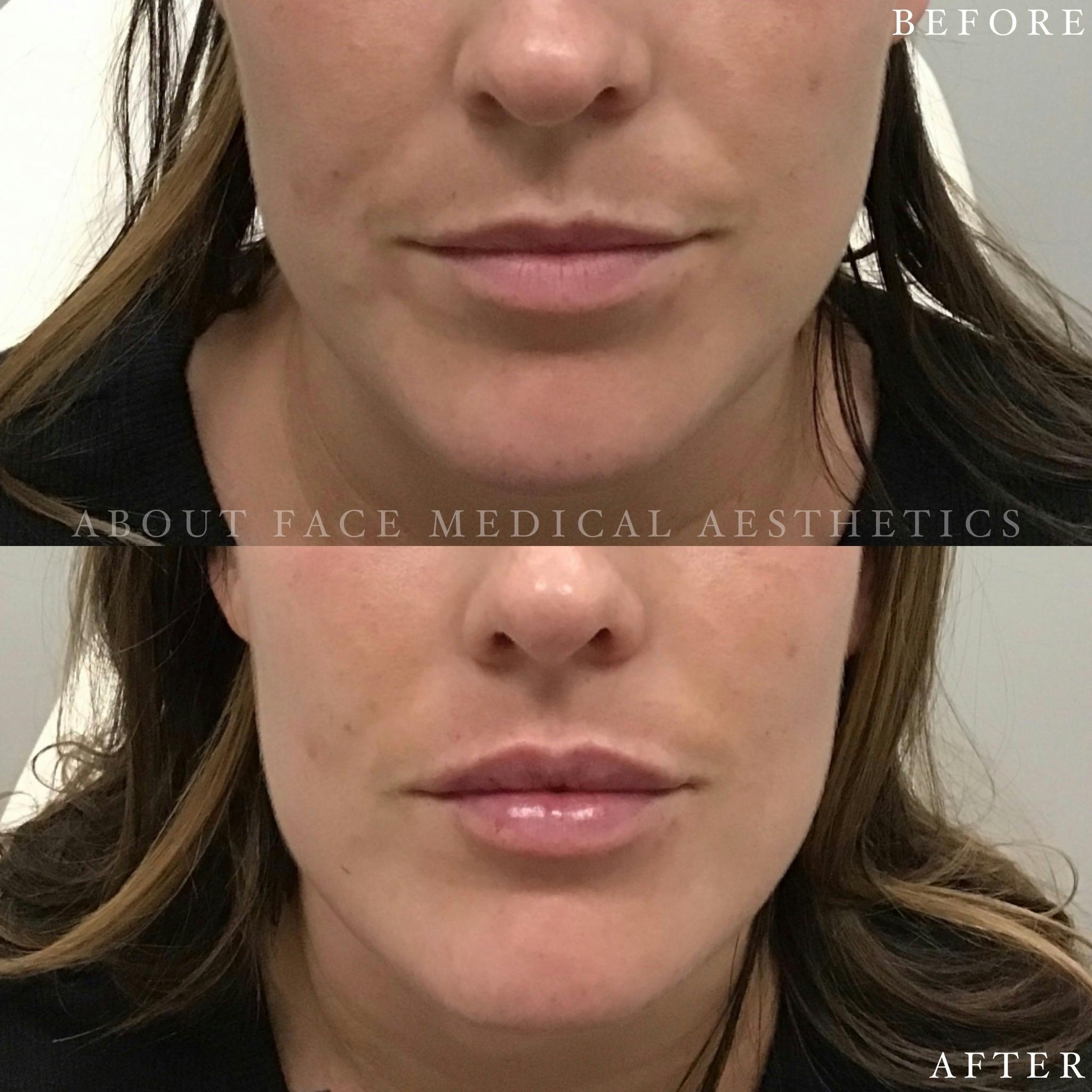 Dermal Filler Before & After Gallery - Patient 152124335 - Image 1