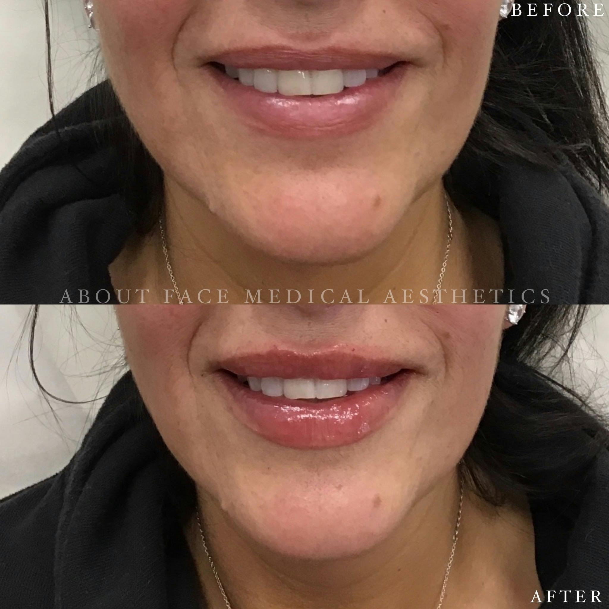 Dermal Filler Before & After Gallery - Patient 152124336 - Image 1