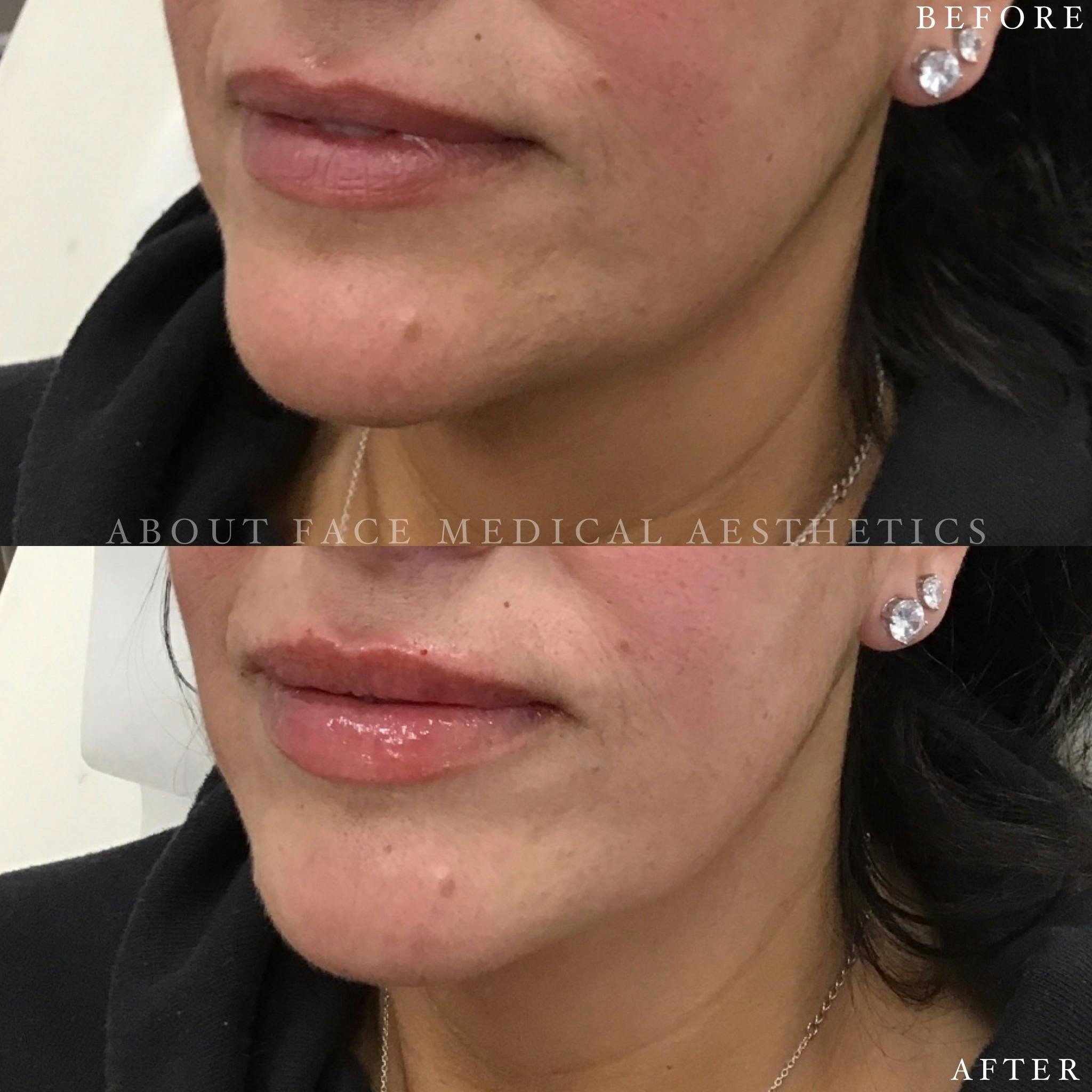 Dermal Filler Before & After Gallery - Patient 152124336 - Image 2