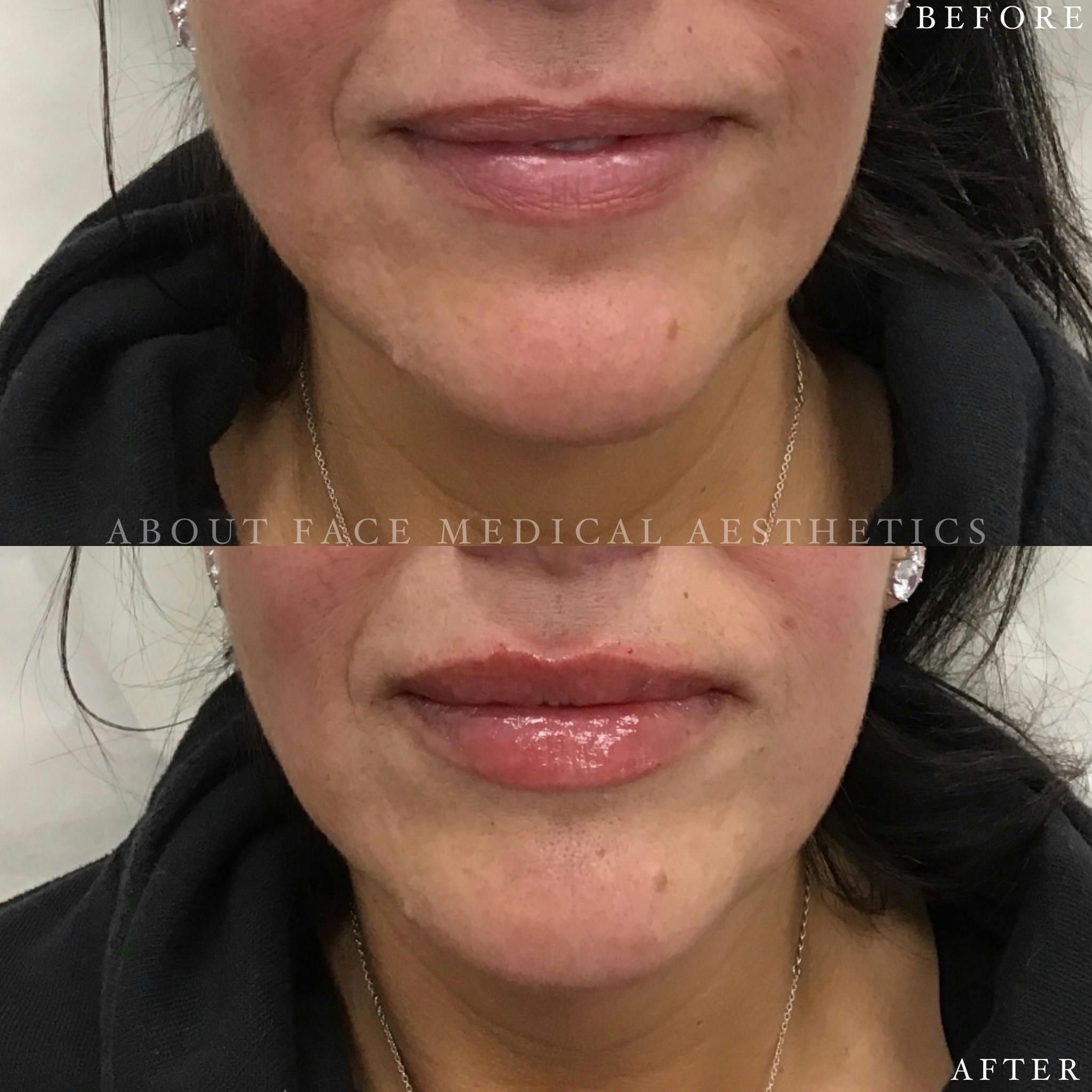 Dermal Filler Before & After Gallery - Patient 152124336 - Image 3