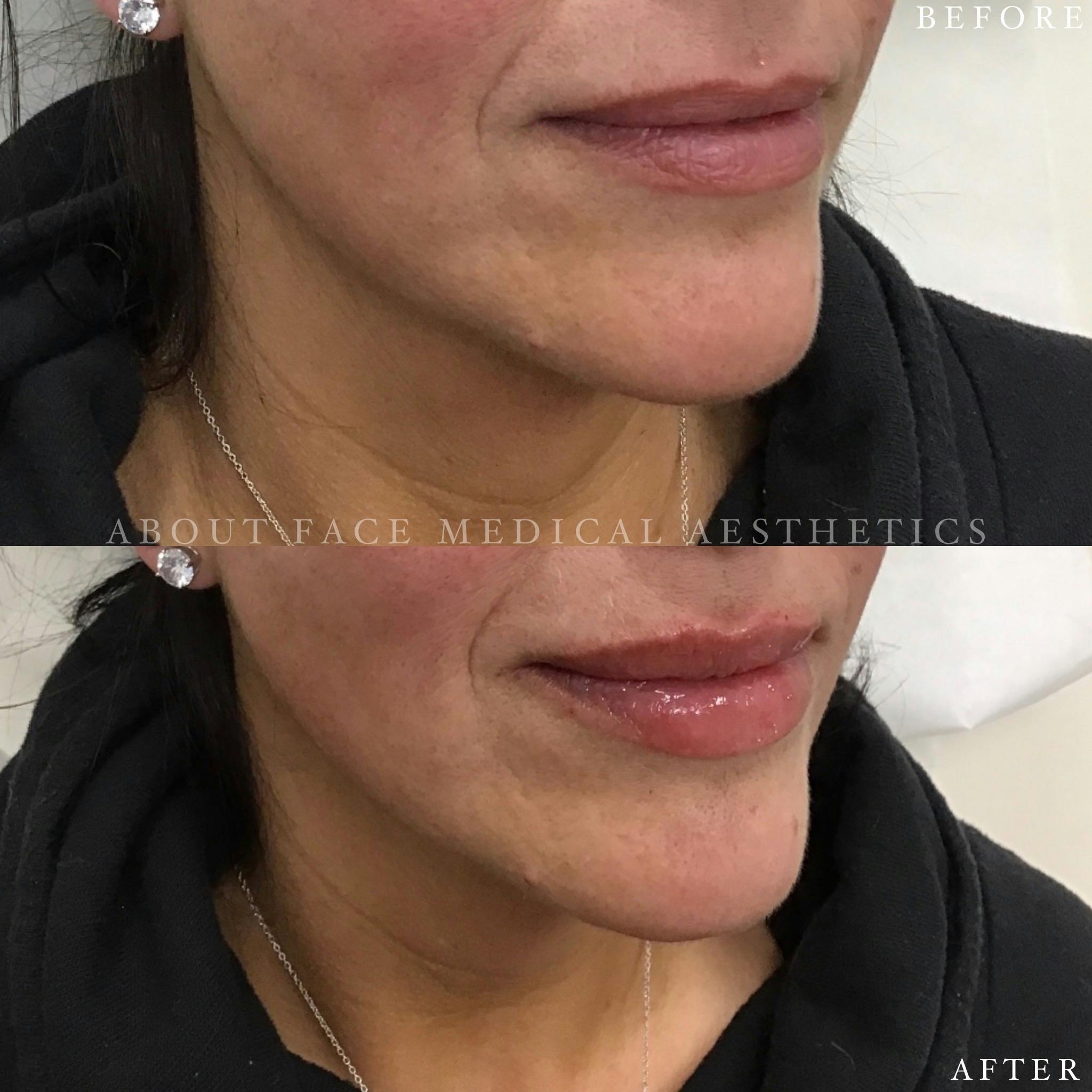 Dermal Filler Before & After Gallery - Patient 152124336 - Image 4