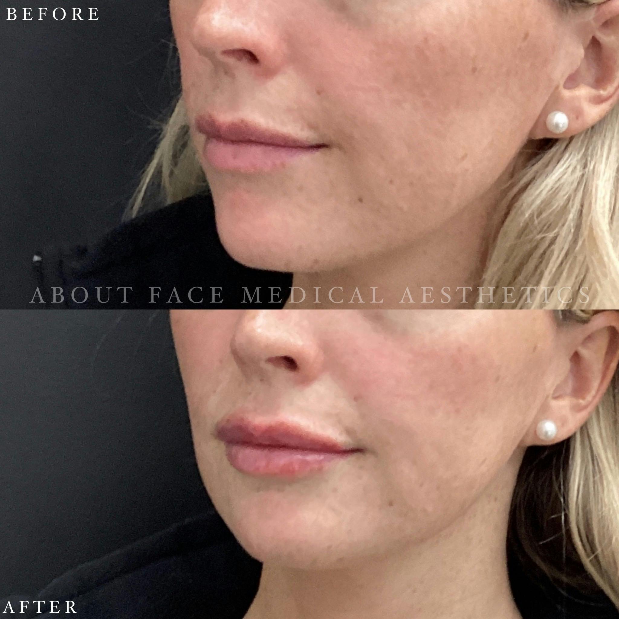 Dermal Filler Before & After Gallery - Patient 152124337 - Image 1