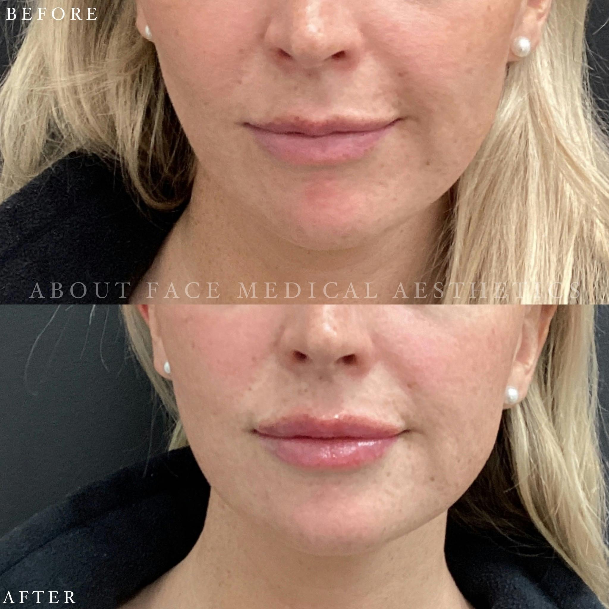 Dermal Filler Before & After Gallery - Patient 152124337 - Image 2