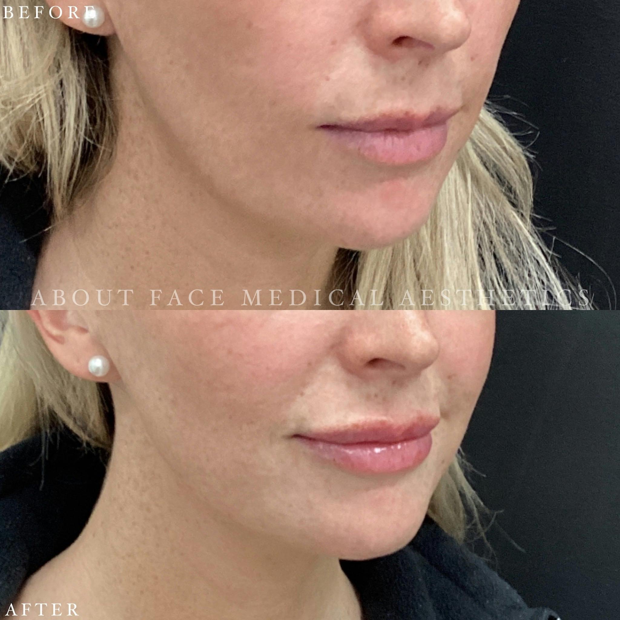 Dermal Filler Before & After Gallery - Patient 152124337 - Image 3