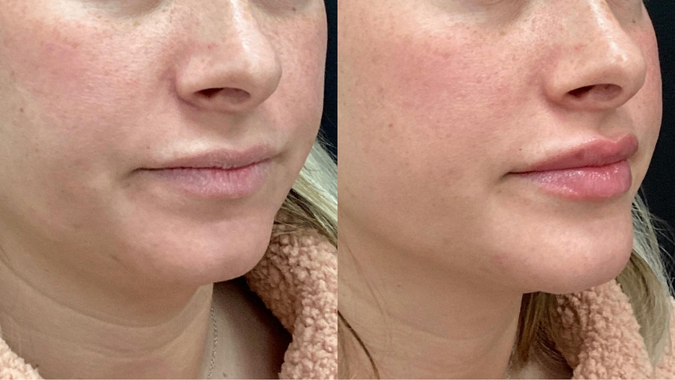 Dermal Filler Before & After Gallery - Patient 152124338 - Image 1