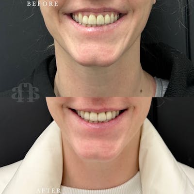 Botox Before & After Gallery - Patient 366784 - Image 1