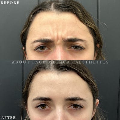 Botox Before & After Gallery - Patient 186517 - Image 1