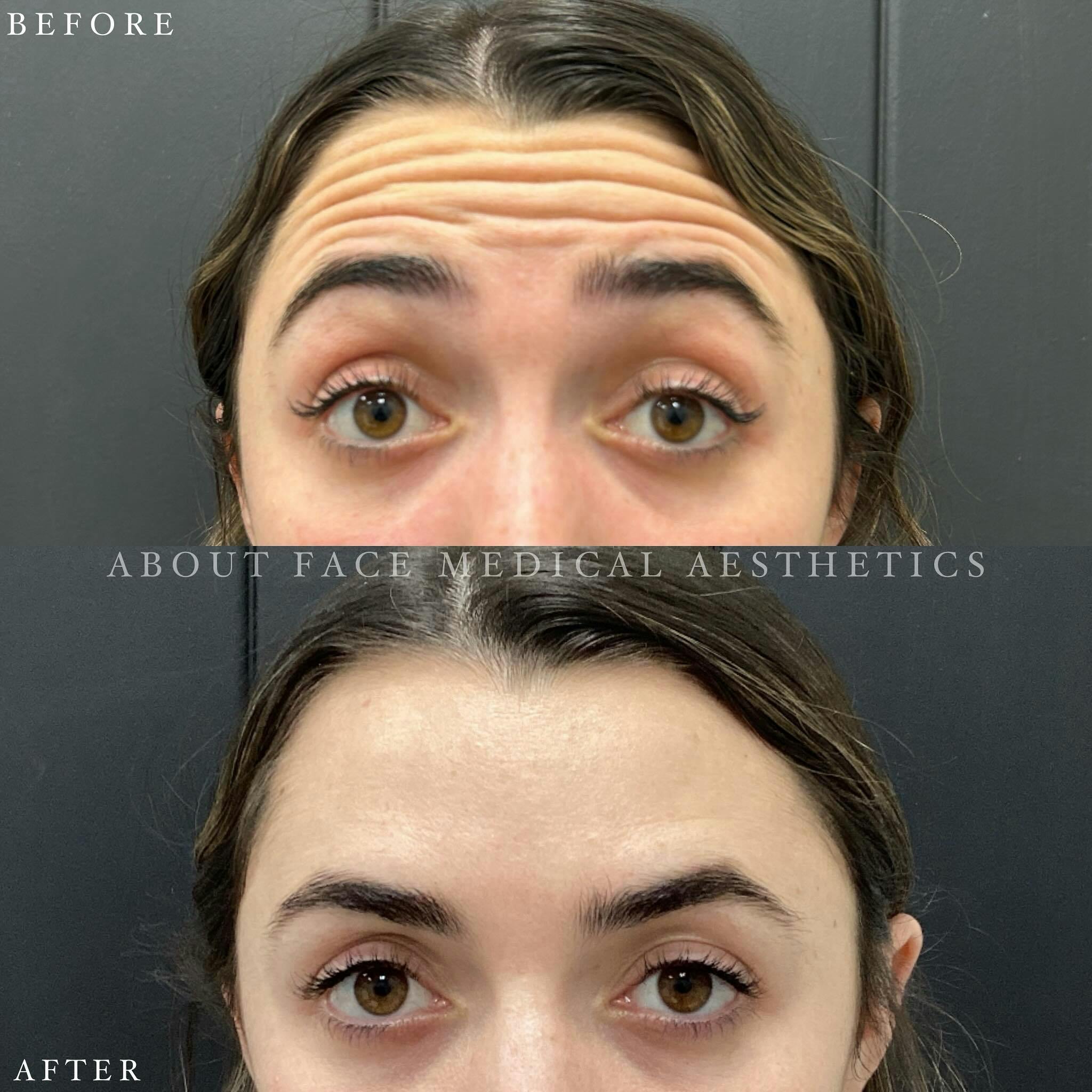 Botox Before & After Gallery - Patient 186517 - Image 2