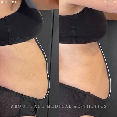 CoolSculpting Before & After Gallery - Patient 168870 - Image 1