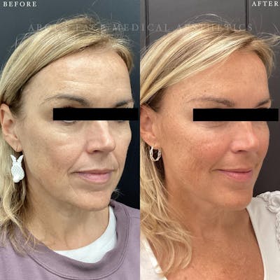 Sculptra Before & After Gallery - Patient 805779 - Image 1