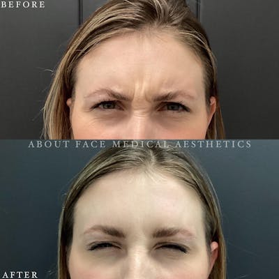 Dermal Filler Before & After Gallery - Patient 423740 - Image 1