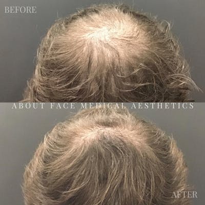 Alma TED Before & After Gallery - Patient 145424 - Image 1