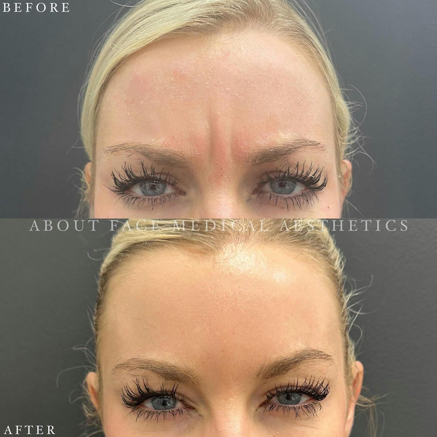 Botox Before & After Gallery - Patient 591426 - Image 1