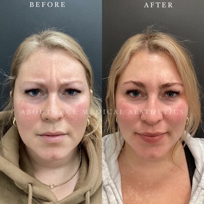 Botox Before & After Gallery - Patient 421297 - Image 1