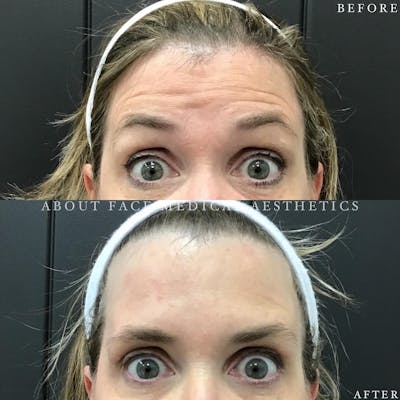 Botox Before & After Gallery - Patient 327811 - Image 1
