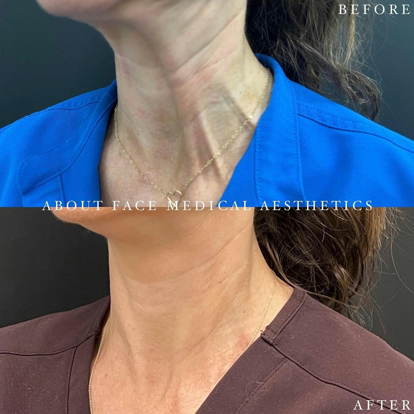 Botox Before & After Gallery - Patient 169215 - Image 1