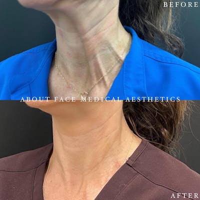 Botox Before & After Gallery - Patient 169215 - Image 1